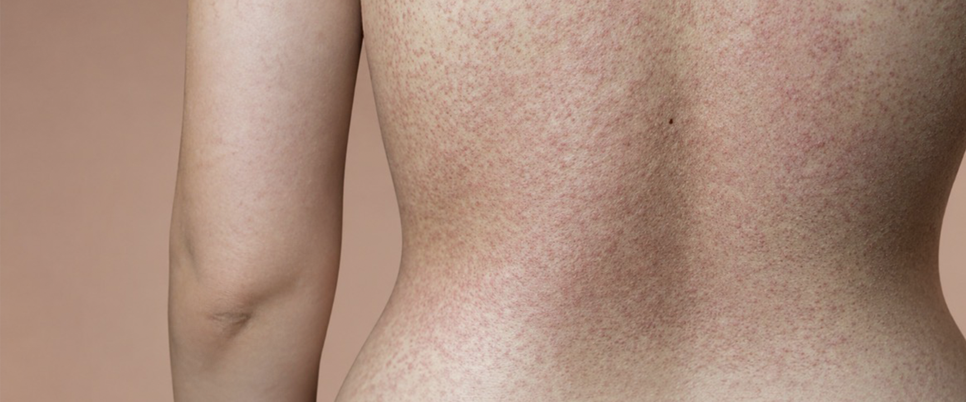 Private Dermatology Consultations and Treatments from Gentle Touch in Marlborough