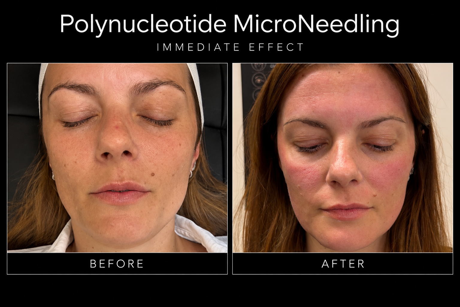 Before / After | Polynucleotide Micro-needling Treatment