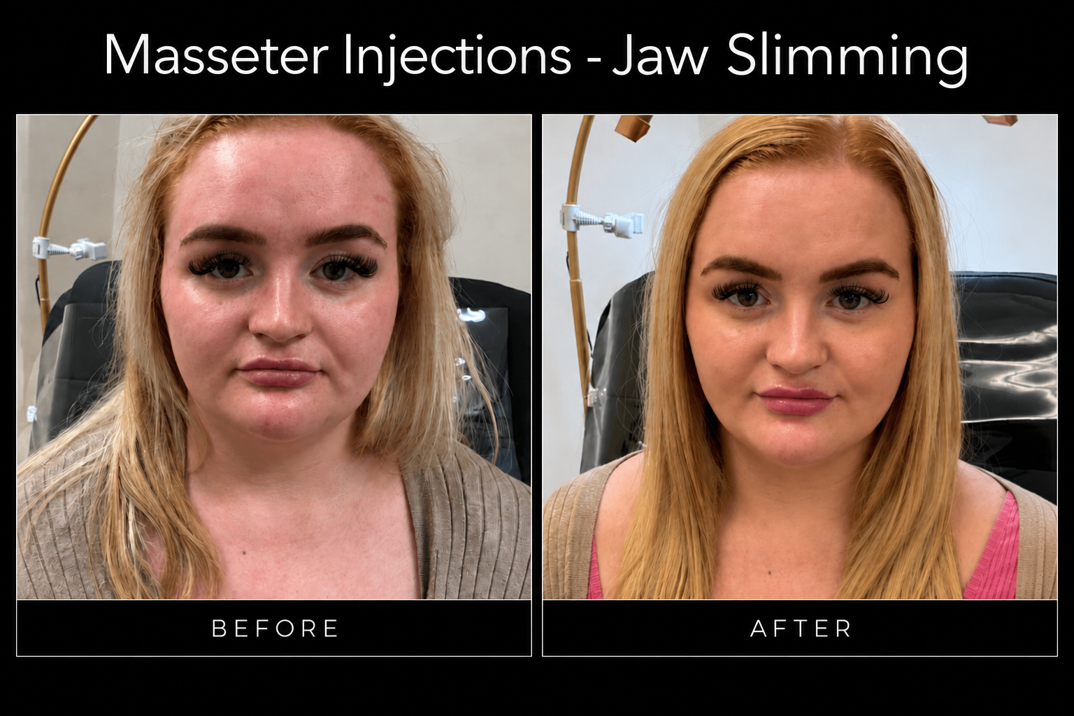 Before / After | Masseter Injections | Jaw Slimming