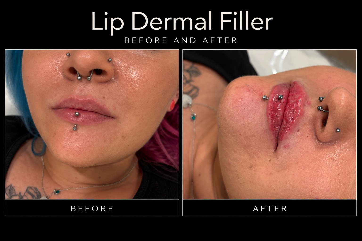 Before / After | Lip Dermal Filler Treatment