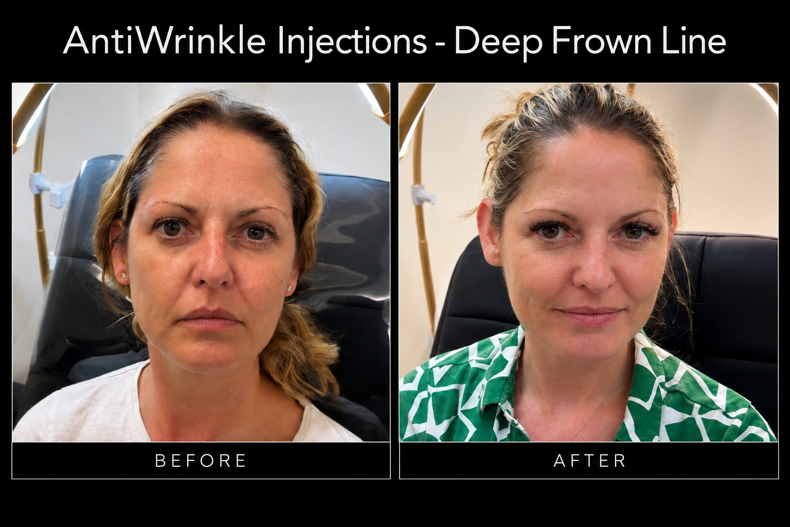 Before / After | Anti-Wrinkle Treatment