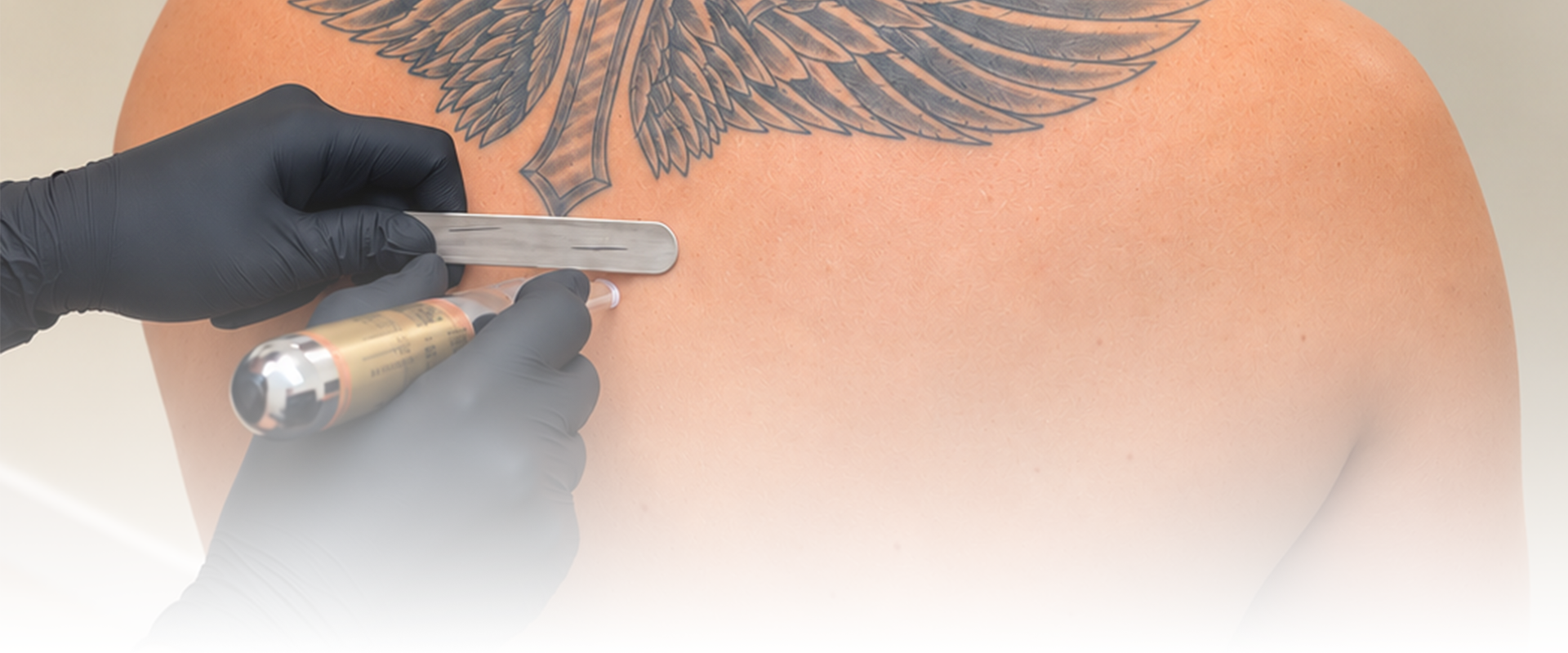 Targeted Cryotherapy from Gentle Touch in Wiltshire